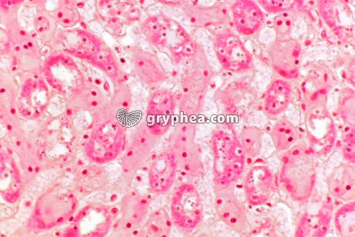 Rejet greffe de rein x 150 - gryphea.org